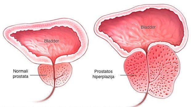 prostatos hiperplazija